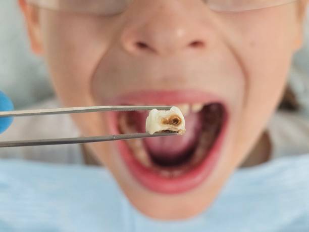 Best Emergency Wisdom Teeth Removal in Ellijay, GA